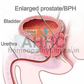 Enlarged Prostate Treatment in Homeopathy Enlarged Prostate Treatment in Homeopathy