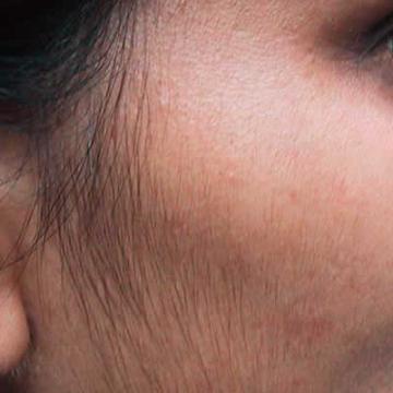 Facial Hair Growth In Females Facial Hair Growth In Females