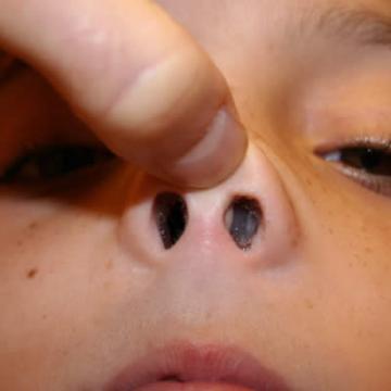Nasal Polyp Nasal Polyp
