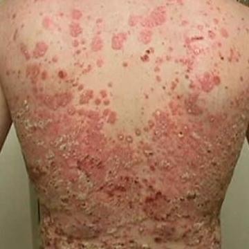 Psoriasis Psoriasis