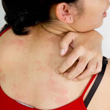 Skin Allergies Skin Allergies